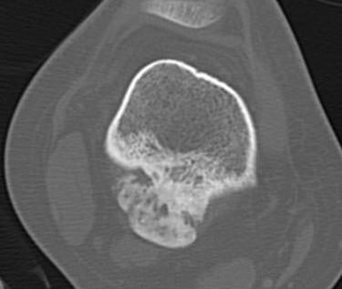 Parosteal Osteosarcoma CT0002